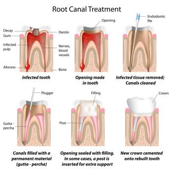 Dentist in Bellandur and Sarjapur Road