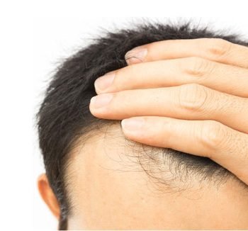 Hair Transplantation Treatment