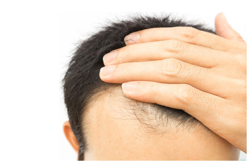 Hair Transplantation Treatment