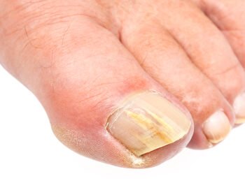 Nail Surgery and Toenail Surgery