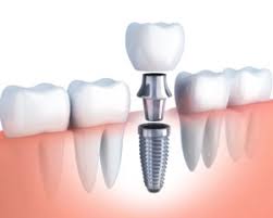 Dental implants are nothing but replacing the tooth roots. Dr. Sunny is a Best Place where you can replace your teeth,They have a best Dentist In Bangalore.