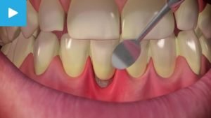 Sensitive Teeth: Causes, Symptoms, Treatments- Dr. Sunny