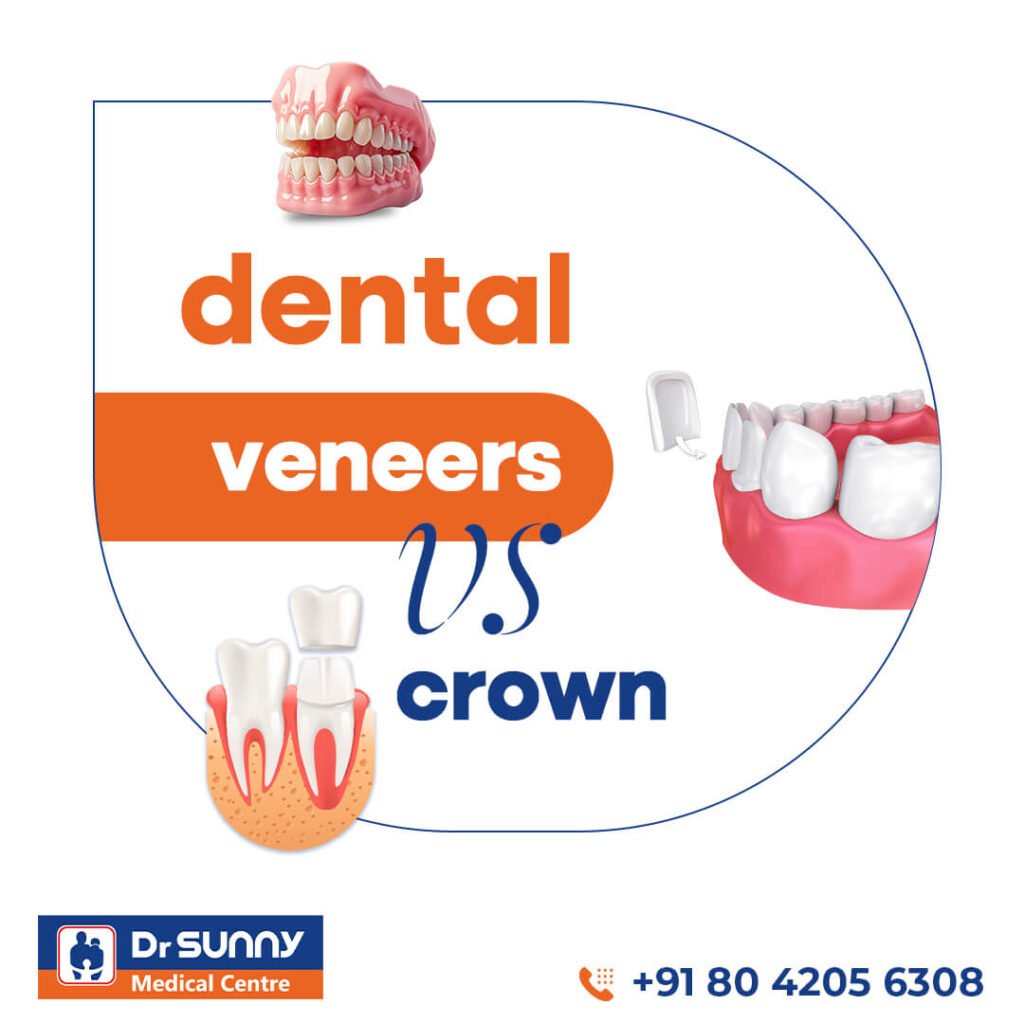 Dental Veneers vs Crown best dentist in bellandur