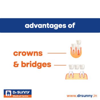 best dental Crowns and Bridges